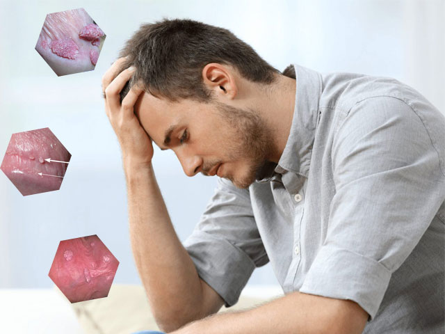 Điều trị sùi mào gà