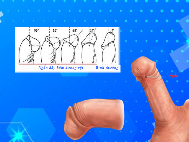 Tạo hình dây hãm dương vật