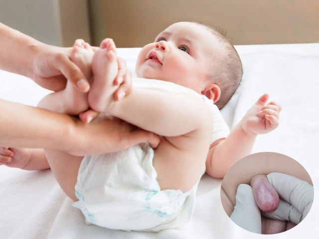 Nong tách bao quy đầu trẻ em